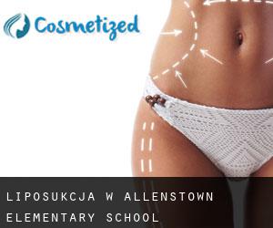 Liposukcja w Allenstown Elementary School