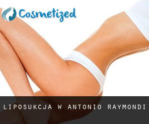 Liposukcja w Antonio Raymondi