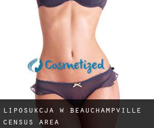 Liposukcja w Beauchampville (census area)
