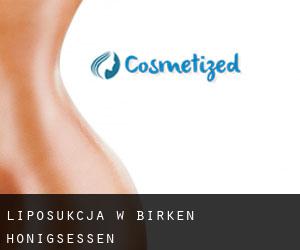 Liposukcja w Birken-Honigsessen