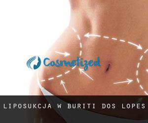 Liposukcja w Buriti dos Lopes