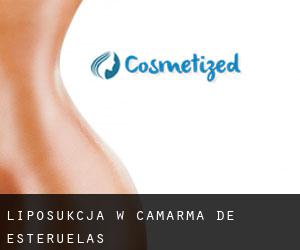 Liposukcja w Camarma de Esteruelas