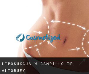 Liposukcja w Campillo de Altobuey