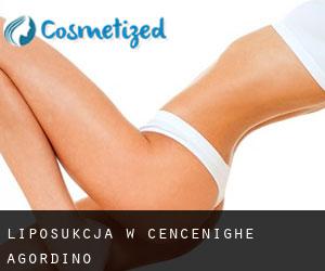 Liposukcja w Cencenighe Agordino