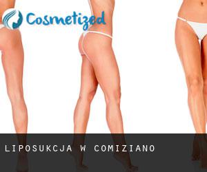 Liposukcja w Comiziano