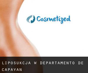 Liposukcja w Departamento de Capayán