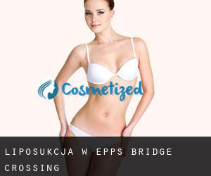 Liposukcja w Epps Bridge Crossing