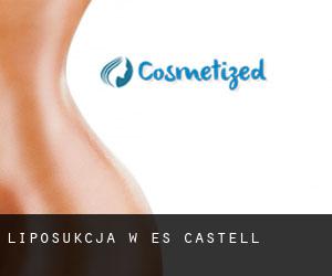Liposukcja w Es Castell