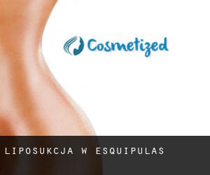 Liposukcja w Esquipulas