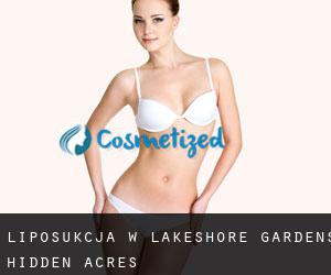 Liposukcja w Lakeshore Gardens-Hidden Acres