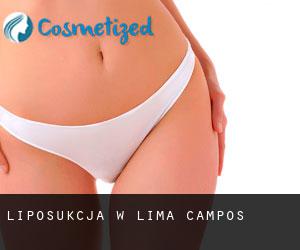 Liposukcja w Lima Campos