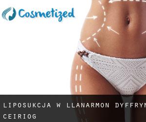 Liposukcja w Llanarmon Dyffryn-Ceiriog