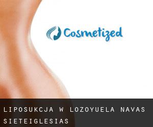 Liposukcja w Lozoyuela-Navas-Sieteiglesias