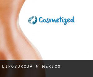 Liposukcja w México