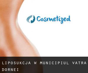 Liposukcja w Municipiul Vatra Dornei