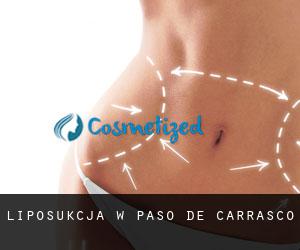 Liposukcja w Paso de Carrasco