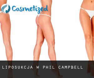 Liposukcja w Phil Campbell
