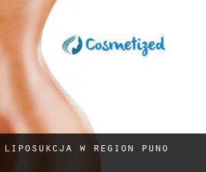 Liposukcja w Region Puno