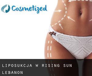 Liposukcja w Rising Sun-Lebanon