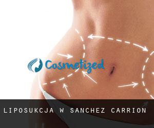 Liposukcja w Sanchez Carrion