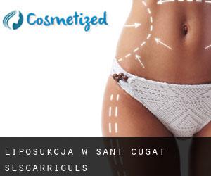 Liposukcja w Sant Cugat Sesgarrigues