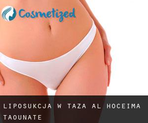 Liposukcja w Taza-Al Hoceima-Taounate