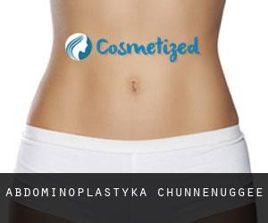 Abdominoplastyka Chunnenuggee