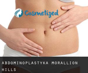 Abdominoplastyka Morallion Hills